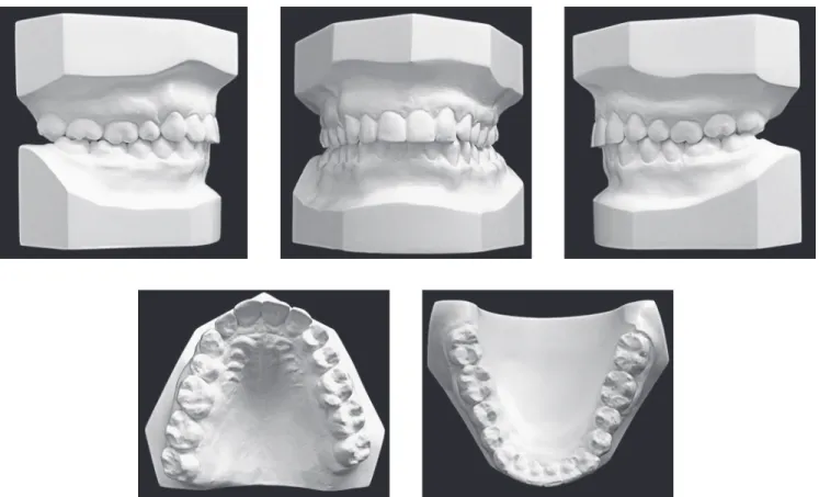 Figure 8 - Final casts.