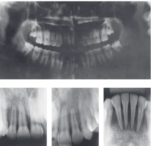 Figure 7 - Final panoramic and periapical radio- radio-graphs of maxillary and mandibular incisors.