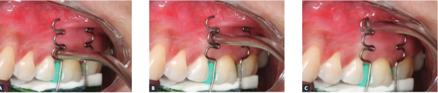 Figure 1 - Guide and scheme of laser applications used in the study. A) 10-second application in the mesio-cervical region; B) 10-second application in the  mesio-medial region; C) 10-second application in the mesio-apical region