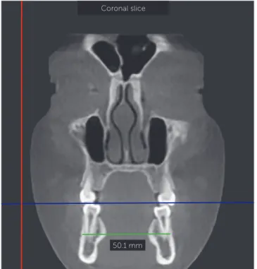 Figure 1 - Coronal slice and transversal width of buccal bone (TWBB).