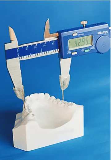 Figure 2 - Buccal bone thickness (BBT) measurements. Figure 4 - Intermolar width measured on a dental cast by means of a  digital caliper.