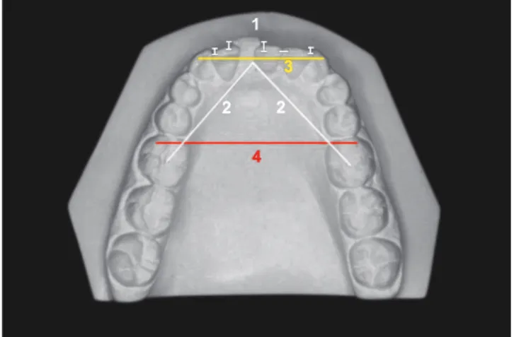 Figure 1 - Irregularity index (1), arch length (2), intercanine width (3) and  intermolar width (4).