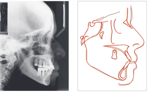Figure 12 - Radiograph 10 years after treatment   completion. Superimposition of  cephalomet-ric tracings at treatment completion (red) and  10 years after treatment (brown)