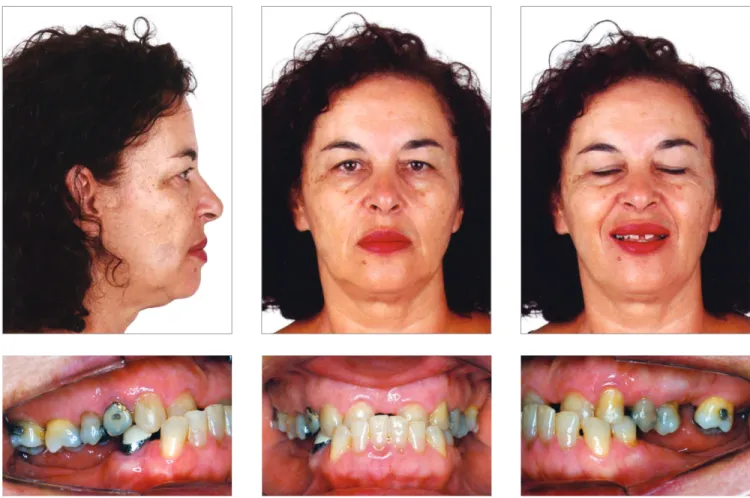 Figure 2 - Initial dental casts.