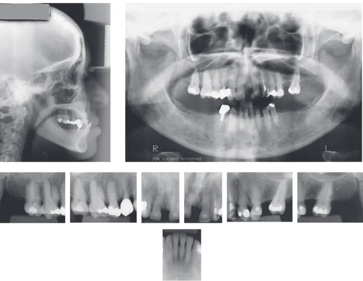 Figure 3 - Initial lateral cephalometric radiograph, panoramic and periapical radiographs.