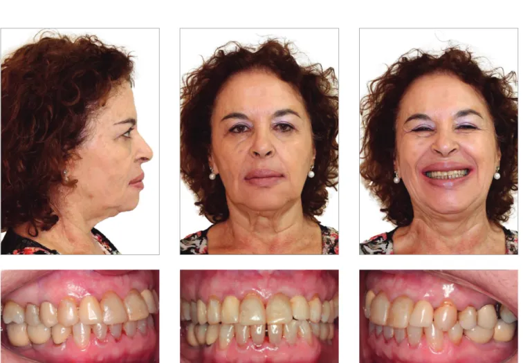 Figure 11 - Facial and intraoral photographs 10 years after treatment completion.