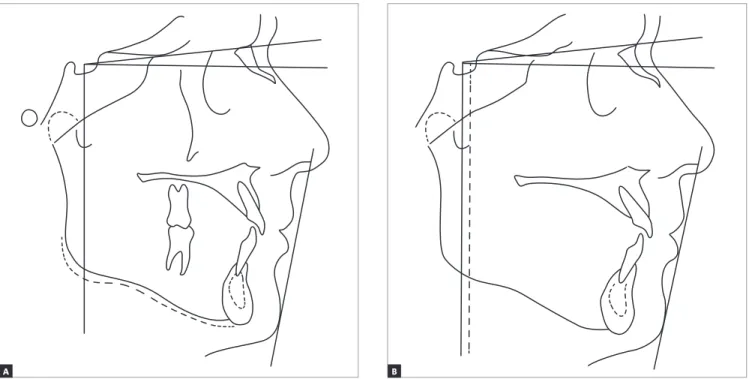 Figure 2 - Sample tracing used to guide profile changes: A) original male tracing; B) modified male tracing (bimaxillary protrusion: dotted line corresponds  to a 3-mm displacement of the VRL).
