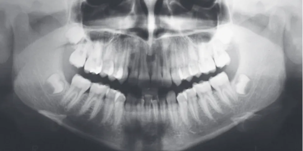 Figure 3 - Initial panoramic radiograph.