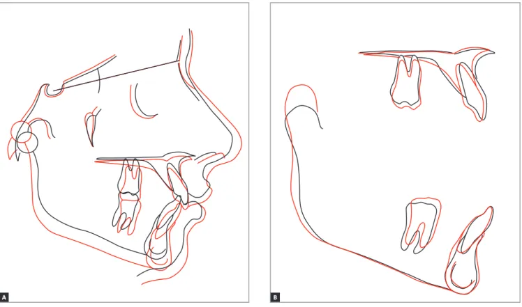 Figure 9 - Total (A) and partial (B) cephalometric superimpositions of initial (black) and final (red) cephalometric tracings.