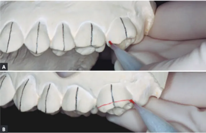 Figure 1. Long axes of teeth marked in black pencil. Figure 2. A) Mark the mesial and distal marginal ridges with red pencil on buccal  surface of teeth