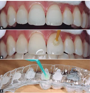 Figure 17. Remove the Cristal tray, pushing it in the occlusal direction.