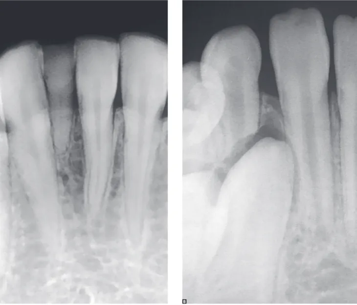 Figure 1. Despite the absence of a permanent tooth to come, in A, root resorption slowly occurs in deciduous teeth