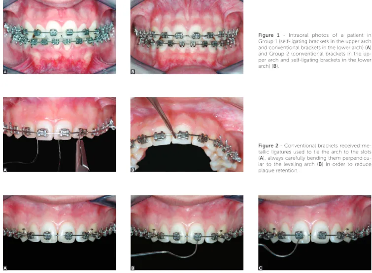 Figure 1 - Intraoral photos of a patient in  Group 1 (self-ligating brackets in the upper arch  and conventional brackets in the lower arch) (A)  and Group 2 (conventional brackets in the  up-per arch and self-ligating brackets in the lower  arch) (B).