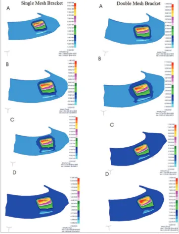 Figure 6 - Comparison of stress generated at the IWM layer for single and  double-mesh bracket bases.