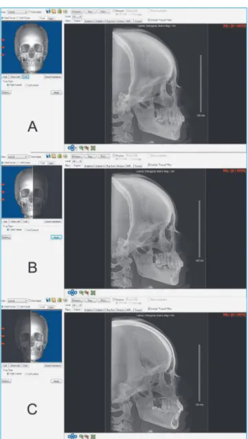 Figure 1 - Different modalities of CBCT-derived cephalograms from the same  subject  A) Full face cephalogram