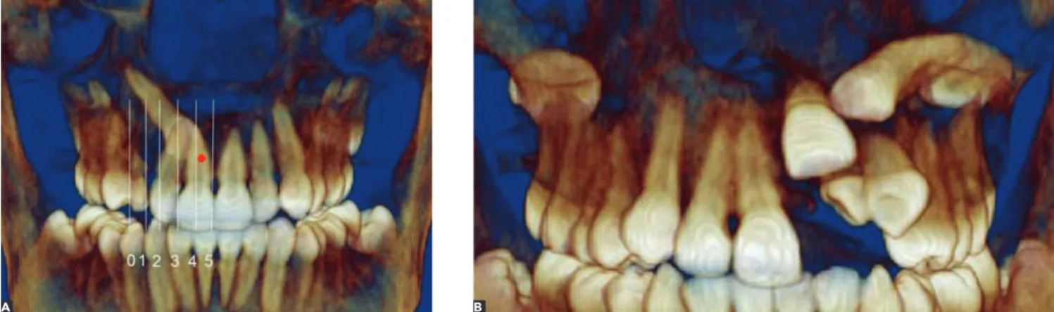 Figure 1 - Four-step evaluation. Step one: Reconstructed 3D image in frontal view used to examine impacted canine