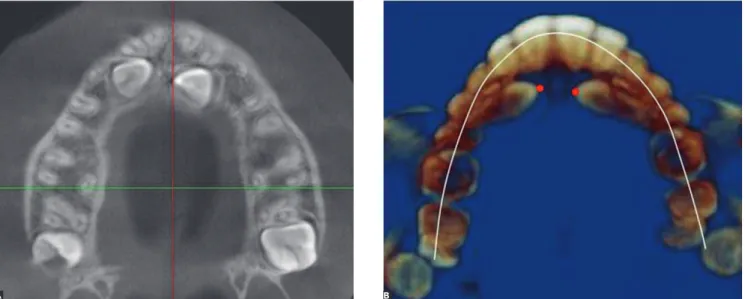 Figure 3 - Four-step evaluation. Step three: Axial view to examine impacted canine. A) Induced root resorption at the closest contact with incisor root and  B) Buccopalatal position at the crown level.