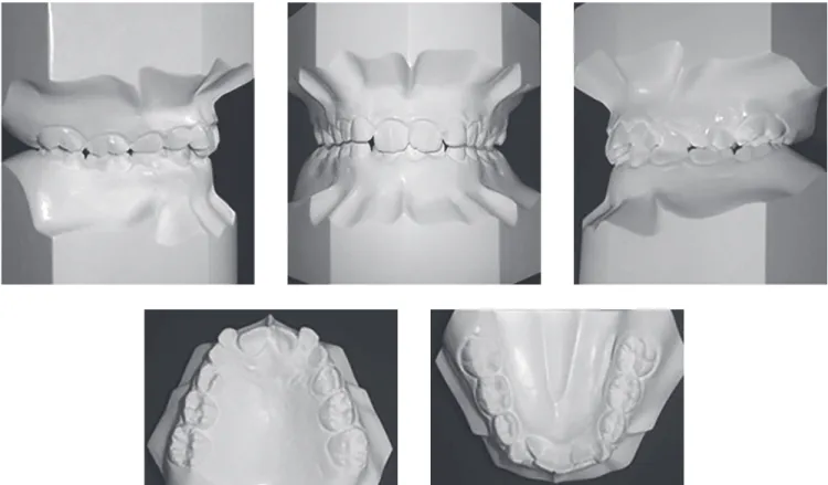 Figure 1 - Pre-treatment dental casts.