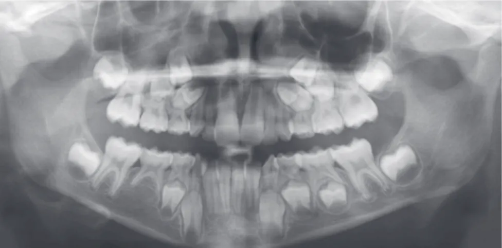 Figure 2 - Initial panoramic radiograph showing  bilateral maxillary permanent lateral incisors and  second right lower premolar agenesis, and initial  bilateral transposition of upper canines and first  premolars.