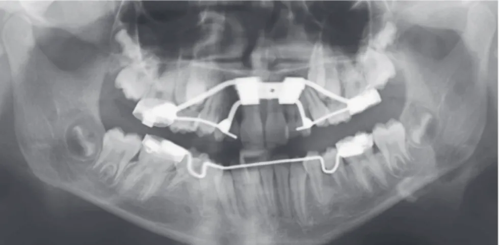 Figure 5 - Pre-treatment panoramic radiograph  taken the very moment the patient came to us for  the second time