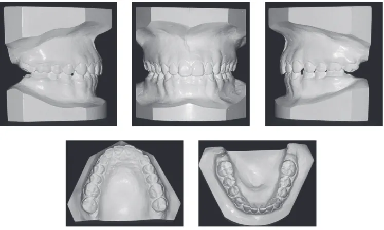 Figure 2 - Initial casts.