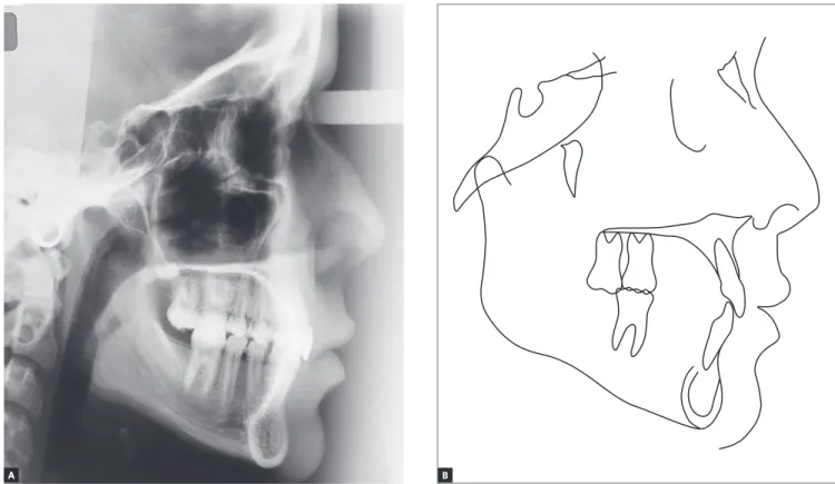 Figure 4 - Initial profile cephalometric radiograph (A) and cephalometric tracing (B).