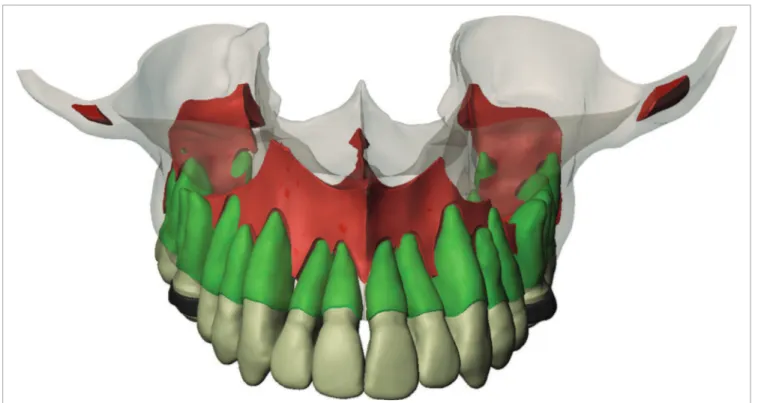 Figure 1. Virtual reconstruction of the maxilla by means of computed tomography.