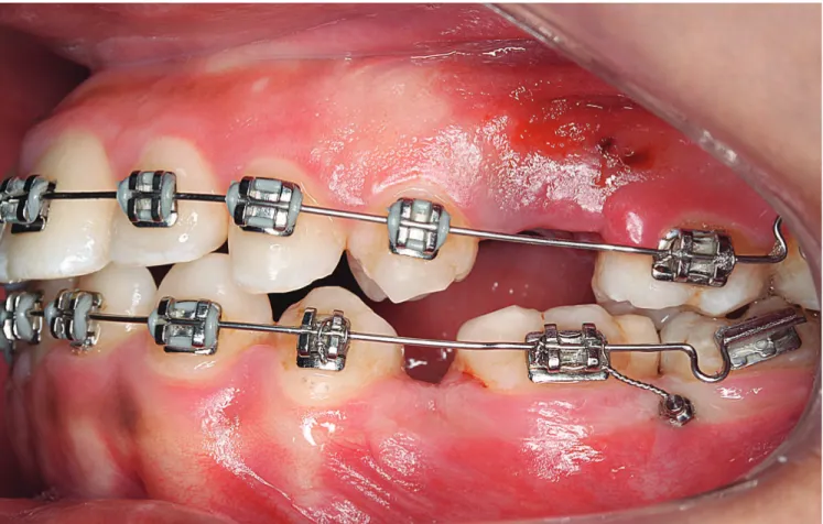 Figure 2. Implant placement failure in area of recent extraction.