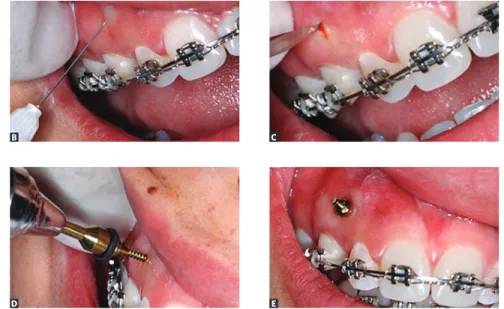 Figure 6. Major steps for mini-implant placement. 