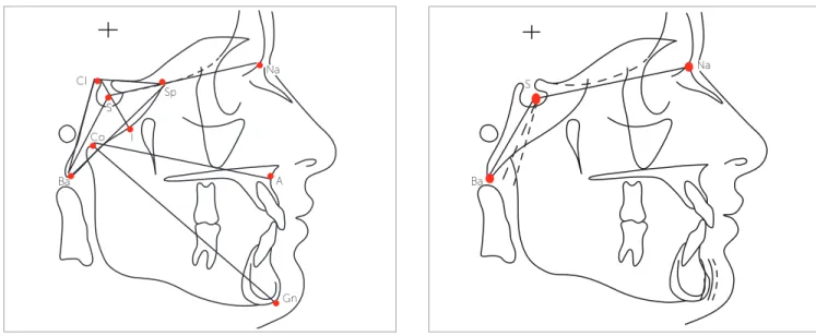 Figure 1 - Cephalometric landmarks, linear and angular measurements. Figure 2 - Ba.S.N angular measurements demonstrating flexure of the base of the  skull angle.