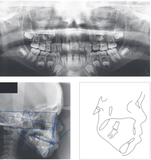 Figure 3 - Panoramic radiograph and lateral cephalogram before treatment.