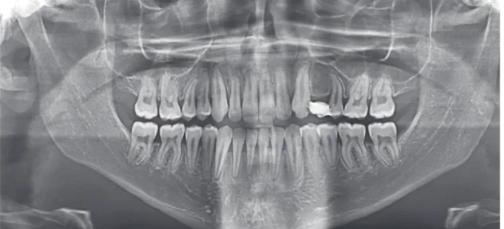Figure 10 - A) Cephalometric superimposition  before and after treatment. B) Maxillary and  mandibular superimposition.