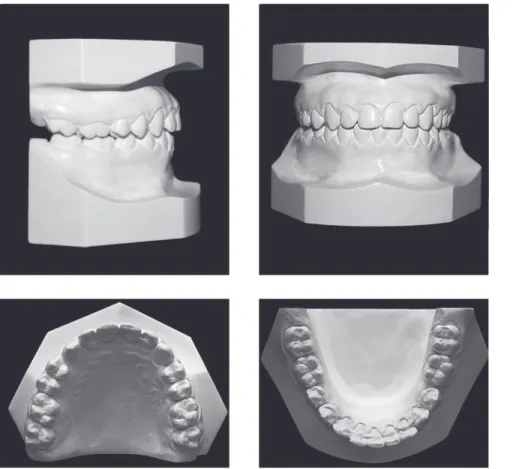 Figure 7 - Post-treatment casts.