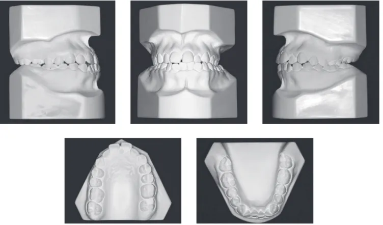 Figure 2 - Initial casts.