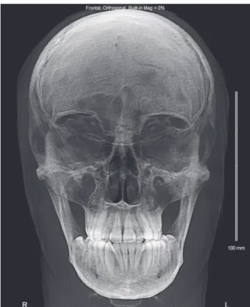 Figure 4 - Initial frontal cephalometric radiograph revealing mild iatrogenesis.