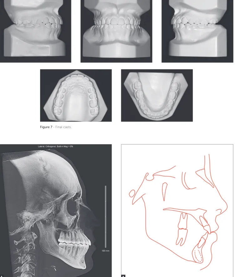 Figure 8 - Final lateral cephalogram (A) and cephalometric tracing (B).