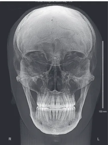 Figure 11 - Final panoramic radiograph.
