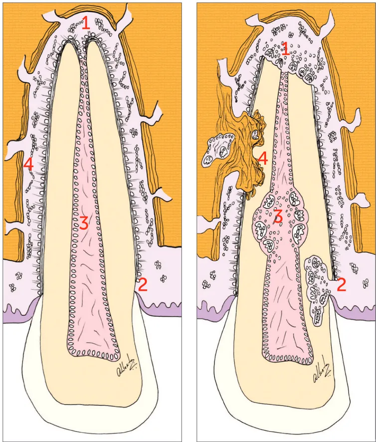 Figure 1 - The destruction or exposure of the four structures that protect the teeth from resorption result in specific imaging scenarios which are char- char-acteristic of the types of tooth resorption