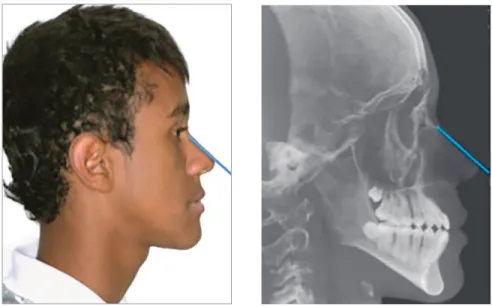 Figure 1 - Reference used for obtaining similar  inclinations between the horizontal planes of  the lateral photograph and radiograph: nasal  dorsum.