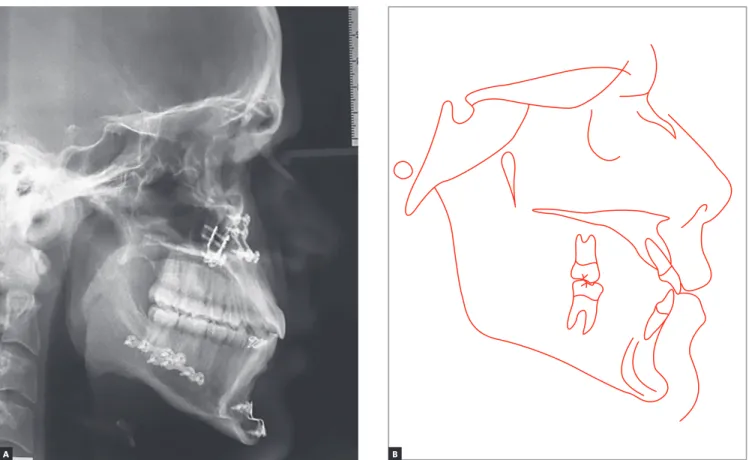 Figure 12 - Final cephalogram (A) and cephalometric tracing (B).