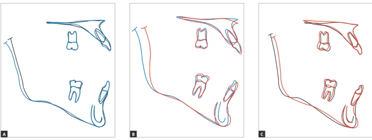 Figure 14 - Partial superimpositions of cephalometric tracings: (A) initial (black) and pre-surgery (blue); (B) pre-surgery (blue) and final (red); (C) initial (black) and  final (red).