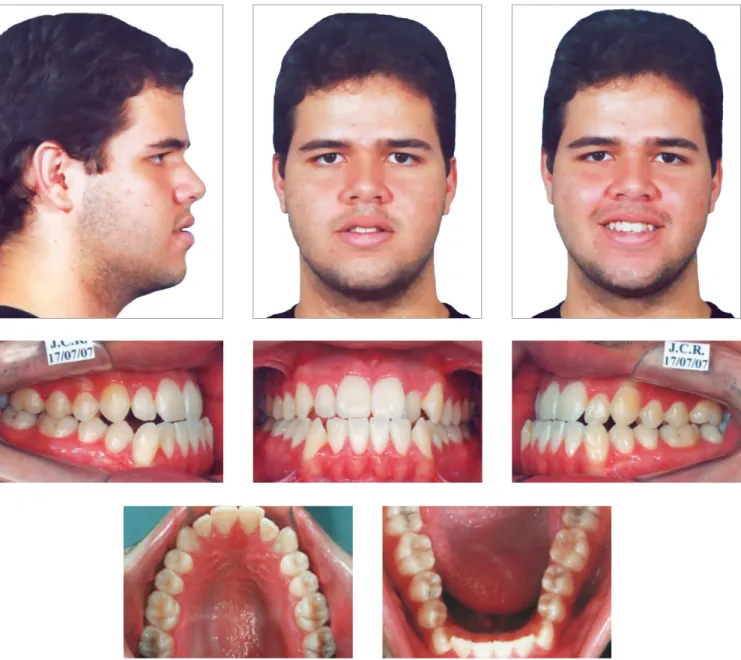 Figure 1 - Initial facial and intraoral photographs.