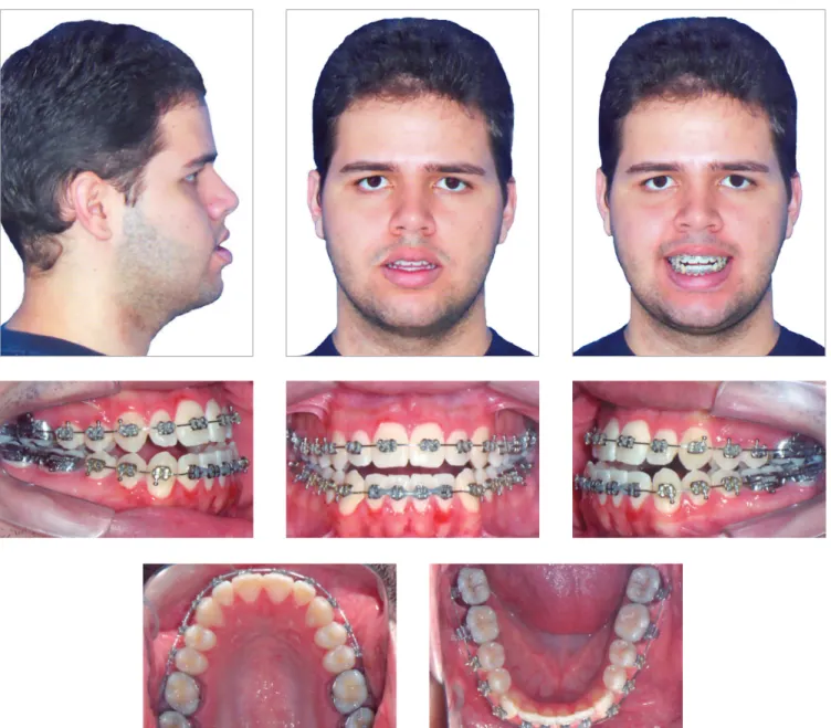 Figure 5 - Intermediate facial and intraoral photographs: presurgical phase.