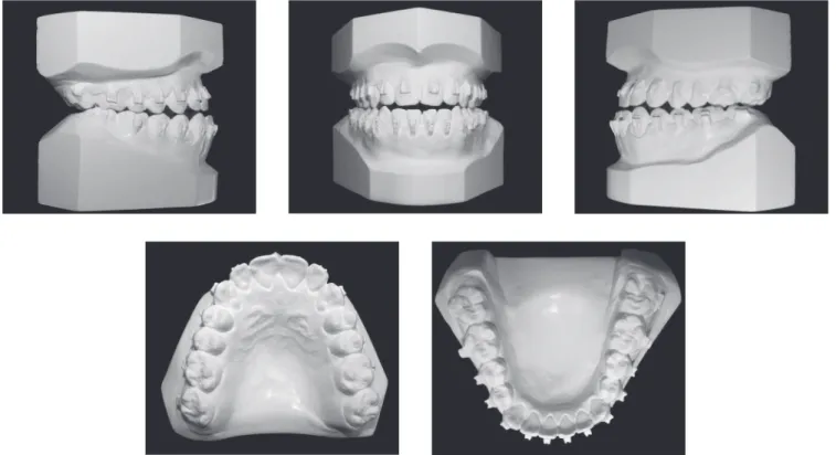 Figure 6 - Intermediate: presurgical phase dental casts.