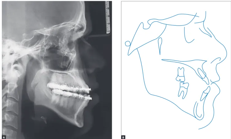 Figure 8 - Intermediate: presurgical phase cephalogram (A) and cephalometric tracing (B).