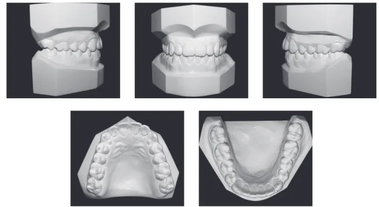 Figure 10 - Final dental casts.