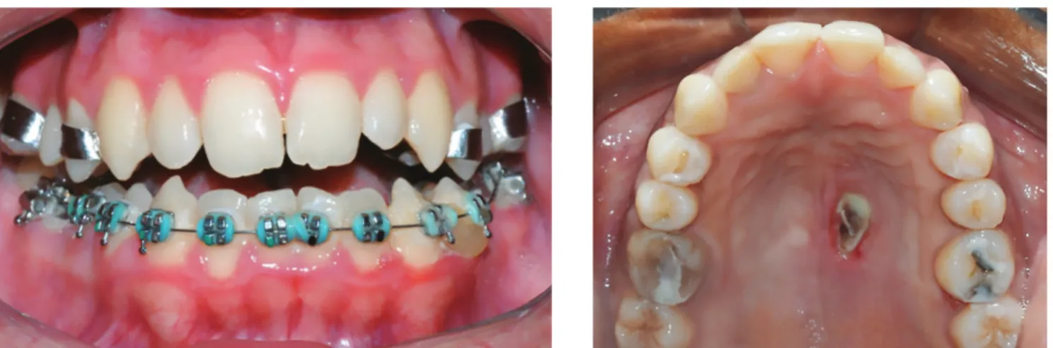 Figure 1 - Side-effects after the RME failure: accentuated buccal inclination of the maxillary posterior teeth and necrosis of the palate