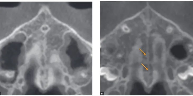 Figure 7 - Stage B appears as a scalloped high-density line (A); or in some areas, two parallel, scalloped high-density lines close to each other and separated by small  low-density spaces – arrows in B