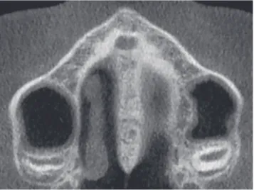 Figure 10 - At Stage E, the midpalatal suture is not visible in at least a portion of  maxilla