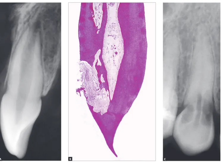 Figure 1 - Mono-radicular tooth radiographically sound, for comparative purpose with B, in which the resorptive external cervical process reveals,  microscopically, preservation of the pulpal limits, due to the fact that the non-mineralized predentine is n